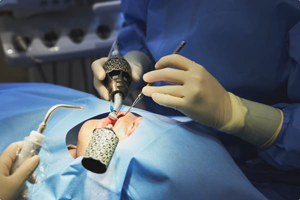 インプラントにもデメリットがあります