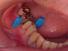 被せ物と隣の歯の隙間のチェック