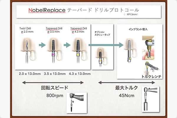 インプラントシステム（ノーベルバイオケア）
