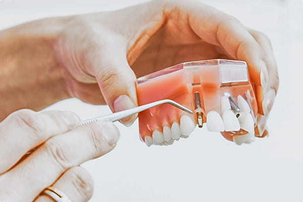 老舗メーカーのインプラントを採用