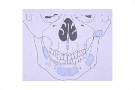 自家骨移植の口腔内供給部位